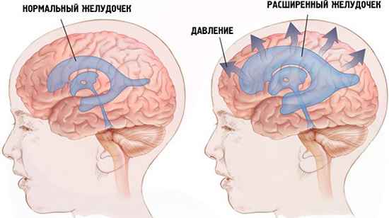 Опухоль головного мозга передается по наследству